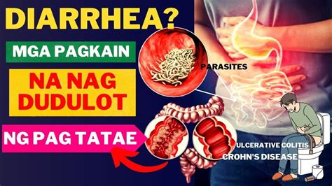 Diarrhea: Sanhi, Sintomas, at Gamot .